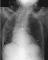 Рентгенограмма органов грудной клетки (А) и компьютерная томограмма органов грудной клетки (В) 75-летнего пациента с вторичным спонтанным пневмотораксом вследствие ХОЗЛ