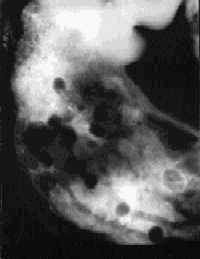 Рентгенограмма множественных полипозов желудка при синдроме Пейтц-Егерса, выглядящих как дефекты заполнения