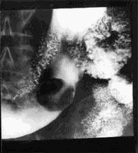 Рентгенограмма гигантского полипа на ножке в кишечнике