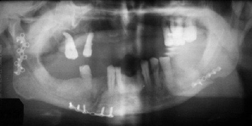 Вид Z-образной минипластины на ортопантомограмме