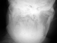 обзорная рентгенография костей лицевого скелета, выполненная на 7 сутки после травмы и двучелюстного шинирования