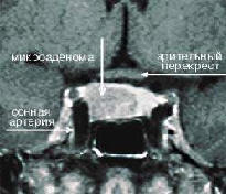 МР-томограмма гипофиза, на которой видна правосторонняя микроаденома, секретирующая АКТГ (гипофиз-зависимая болезнь Кушинга)
