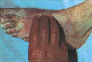 Рис. 1 ХОЗАНК. Типичные изменения кожи: атрофия, бледность, потеря волосяного покрова, трофические изменения ногтей. Видна также язва на тыльной поверхности фаланги 3-го пальца. Пульсация на a. dorsalis pedis снижена или отсутствует. 